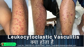 Leukocytoclastic Vasculitis  sudden red rashes  red spot on leg palpable purpura Dr Uttam Lenka [upl. by Aleina]