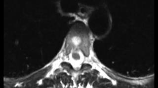 Typical and Atypical Hemangioma [upl. by Kimmel547]