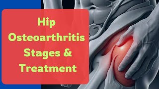 Understanding Hip Osteoarthritis Stages and Treatments Explained [upl. by Prendergast]