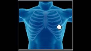 S4gallop myocardial infarction [upl. by Auot]