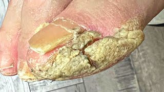 Trimming Extremely THICK And Cracked Callus [upl. by Ennagem143]