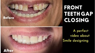 Front teeth gaping treatment with Zirconia Crowns  solution for space between front teeth [upl. by Winslow]