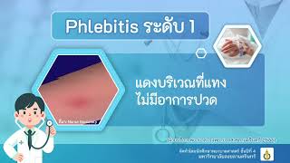 ภาวะหลอดเลือดดำอักเสบ Phlebitis หอผู้ป่วยพิเศษเฉลิมพระบารมี 9 โรงพยาบาลสงขลานครินทร์ [upl. by Helyn]