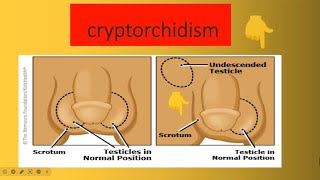 Cryptorchidism [upl. by Ogawa]