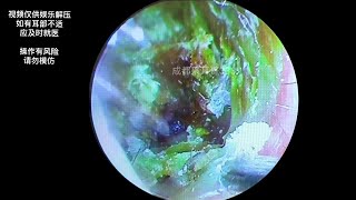 采耳哥Cleaning of cholesteatoma of external auditory canal  333 [upl. by Nimesh]