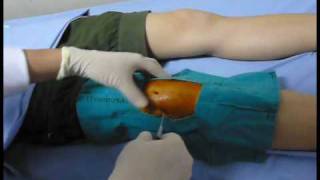 Knee aspiration technique Knee synovitis เจาะเข่า เข่าอักเสบ [upl. by Oaoj242]