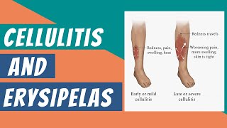 What are Cellulitis And Erysipelas  its Clinical features  Diagnosis amp Treatment  Dermatology [upl. by Tani830]