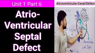 atrioventricular septal defect  avsd symptoms pathophysiology and complications  avsd repair [upl. by Ikuy510]