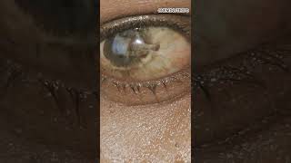 Corneal Degeneration Decoded ophthalmology mbbs neet neetpg eyedoctor shorts [upl. by Regan]