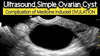 Ultrasound Simple Ovarian CYST  Complication of Medication induced Ovulation [upl. by Llertal]