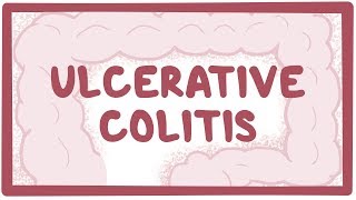 Ulcerative colitis  causes symptoms diagnosis treatment pathology [upl. by Hakeber917]