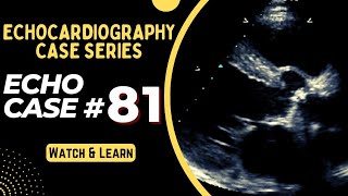 ECHO CASE 81  Echocardiography Spot Diagnosis Series  Echocardiogram Interpretation made easy [upl. by Elwyn]