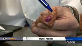 Thyroid Nodules [upl. by Ahsitaf]