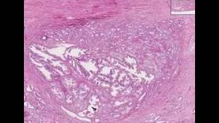 Histopathology ProstateAdenocarcinoma Gleason grade 1 [upl. by At]