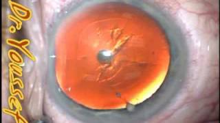 Anterior polar Cataract [upl. by Laet]