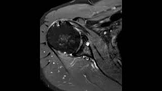 Subcoracoid impingment and subscapularis tendon tear [upl. by Jenilee]