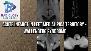 Acute infarct in left Medial PICA territory  Wallenberg syndrome [upl. by Varrian]