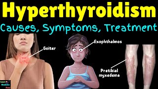 Hyperthyroidism Overactive Thyroid Causes Symptoms Diagnosis Treatment Complications [upl. by Omura906]