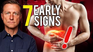 7 Early Signs of Liver Damage [upl. by Rube]