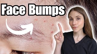 Face Bumps THAT ARE NOT Fungal Acne [upl. by Madelyn316]