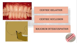 Centric Relation  Centric Occlusion  Maximum Intercuspation [upl. by Curt]