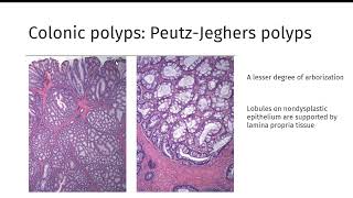 GI polyps GIPATH [upl. by Carvey]