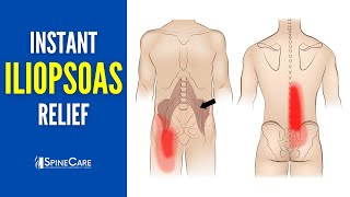 How to Instantly Relieve Iliopsoas Muscle Tightness AND PAIN [upl. by Ennovihc350]