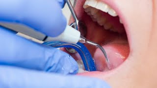 Stop Parodontitis in its tracks  How to recognize and treat this serious gum disease [upl. by Jaymee180]