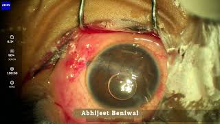 Corneal perforation repair extending upto the limbus [upl. by Thamos345]