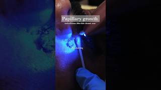 Mole removal laser treatment lasertreatment drrichadubey painlesslaser shortsfeed trending [upl. by Best]