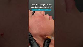 How Does Sculptra Work [upl. by Eli]