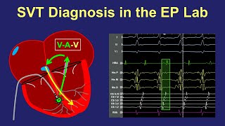 Diagnosis of SVT in the EP lab [upl. by Aleirbag]