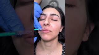 BOtulinum TOXin LIP FLIP  Dr MediSpa [upl. by Lukash]