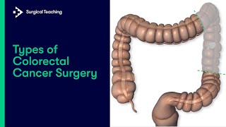 Types of Colorectal Cancer Surgery  What are the Different Operations We Can Perform [upl. by Clava572]