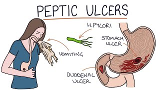 Understanding Stomach and Duodenal Ulcers [upl. by Eilsew]