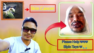 PLEASE HELP korok Bipin Taye  Skin Cancer hoi akranto hoi ase aijon jubok 🙏sckincanceranandapao [upl. by Lletnahc553]