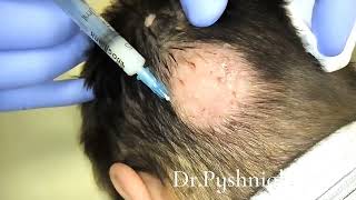 Intralesional corticosteroid injections for alopecia areata [upl. by Abate]