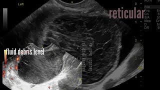 Types of hemorrhagic cysts of ovaries ultrasound and color Doppler video [upl. by Erodroeht]