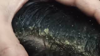 Dandruff Big Flakes Dandruff Scratching Satisfying [upl. by Aidualc]