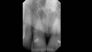 Quiz Radiolucency in anterior maxillary PA [upl. by Sewole231]