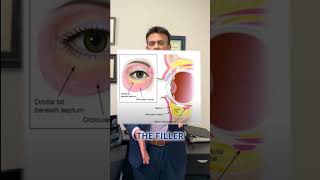 Tampa Under Eye Filler [upl. by Adnopoz]