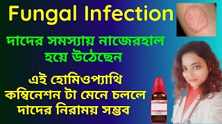 Ringworm Fungal Infection Homeopathic Medicine Best Combination  দাদের বেস্ট হোমিওপ্যাথি ওষুধ [upl. by Ylera]