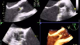 AORTIC FLAIL  ROLE OF 3D TEE [upl. by Auqinet]