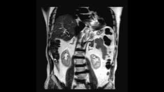 Abdomen MRI exam at 15 Tesla [upl. by Ever]