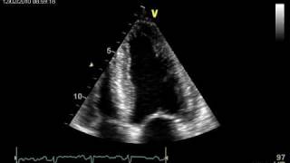 LONGITUDINAL LV DYSFONCTION CARDIAC AMYOIDOSIS [upl. by Tiffie]