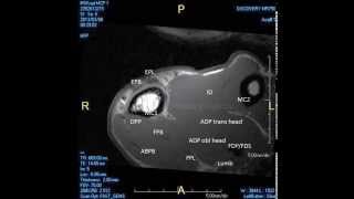 MRI partial rupture radial collateral ligament MCP 1 joint [upl. by Ahcire]