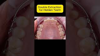 Double Extraction for Hidden Teeth Braces Transformation Journey [upl. by Gnaht]