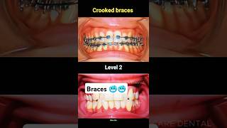 3 level teeth braces braces orthodontist dentistry dental [upl. by Felicdad616]