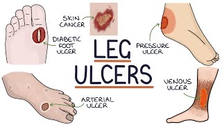 Understanding Leg and Foot Ulcers [upl. by Stempien988]