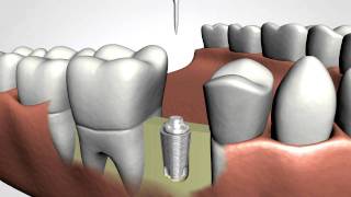 Dental Implants [upl. by Annahtur]